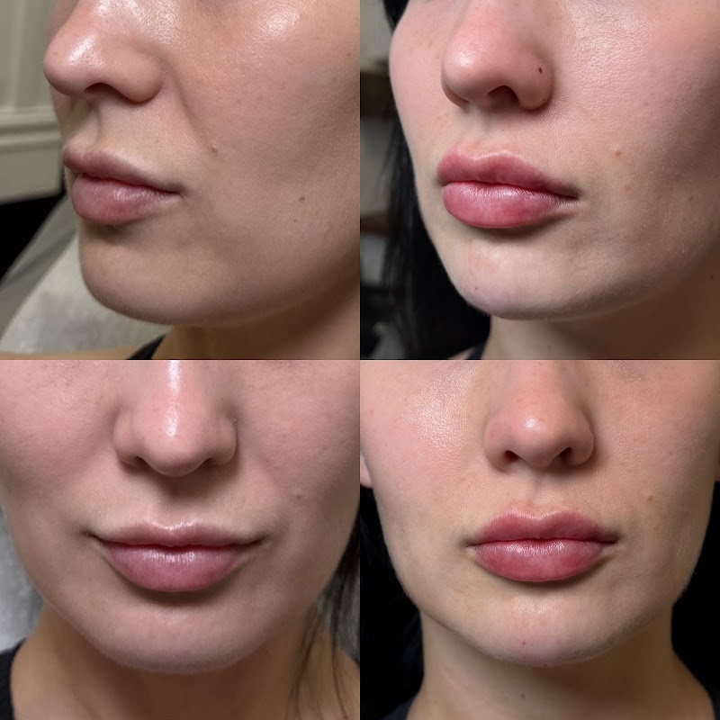 Photo of Botox with Erin