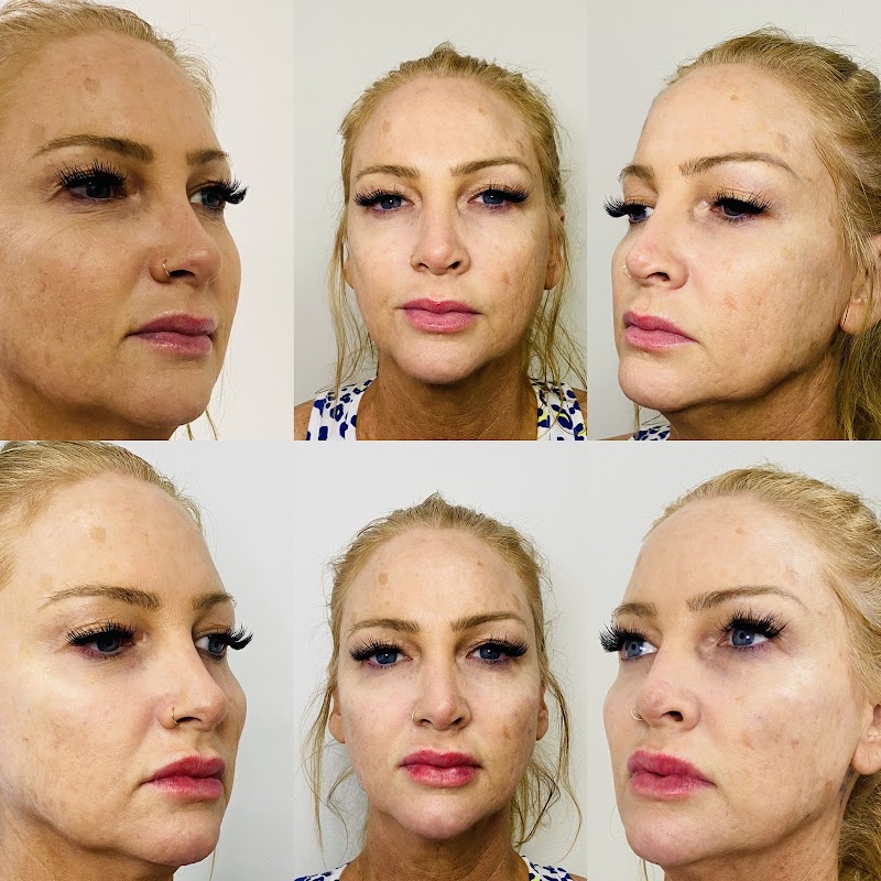 Botox with Erin photo 4