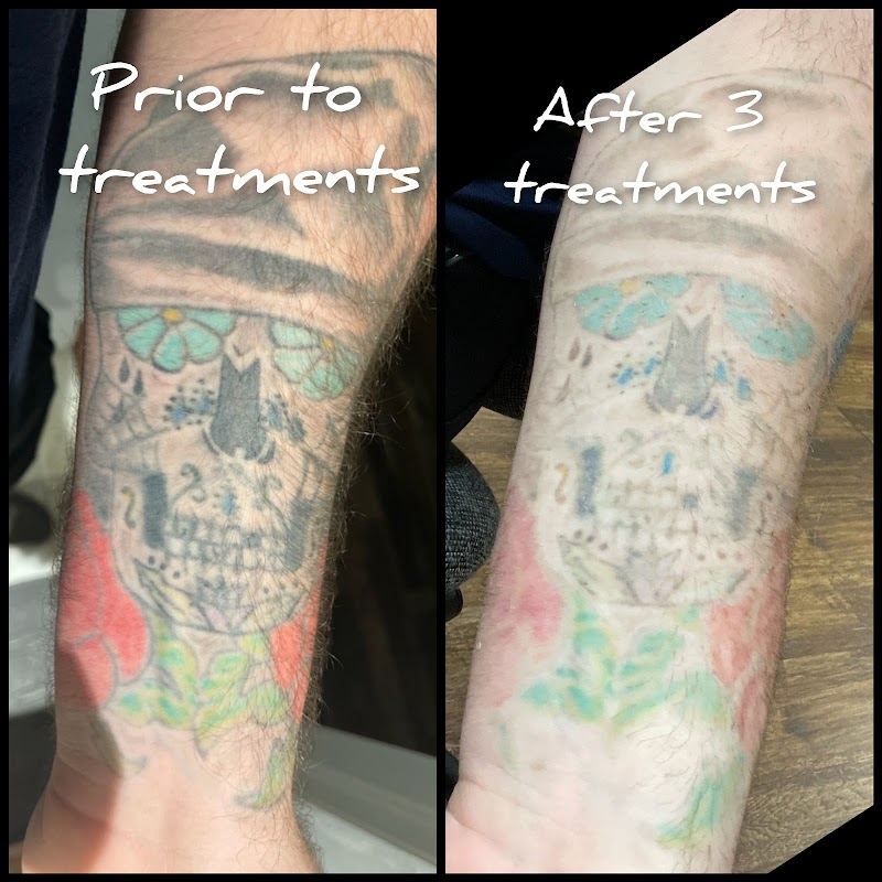 Precision Laser Tattoo Removal photo 4