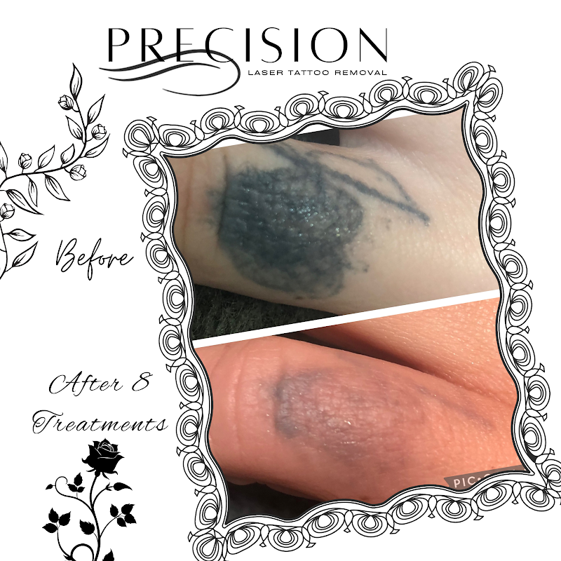Precision Laser Tattoo Removal photo 5