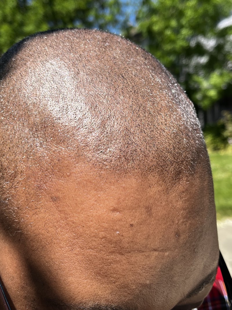 Envision Microscalp photo 3
