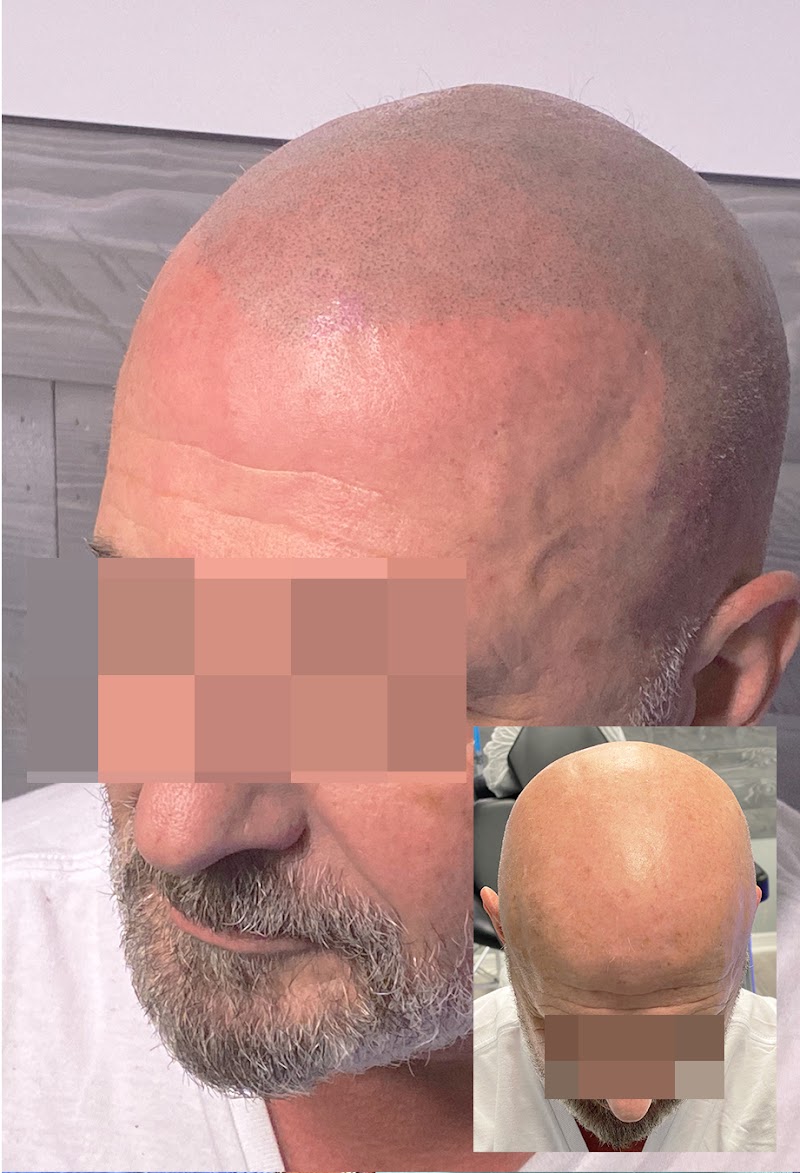 Ultra Scalp Micropigmentation photo 3