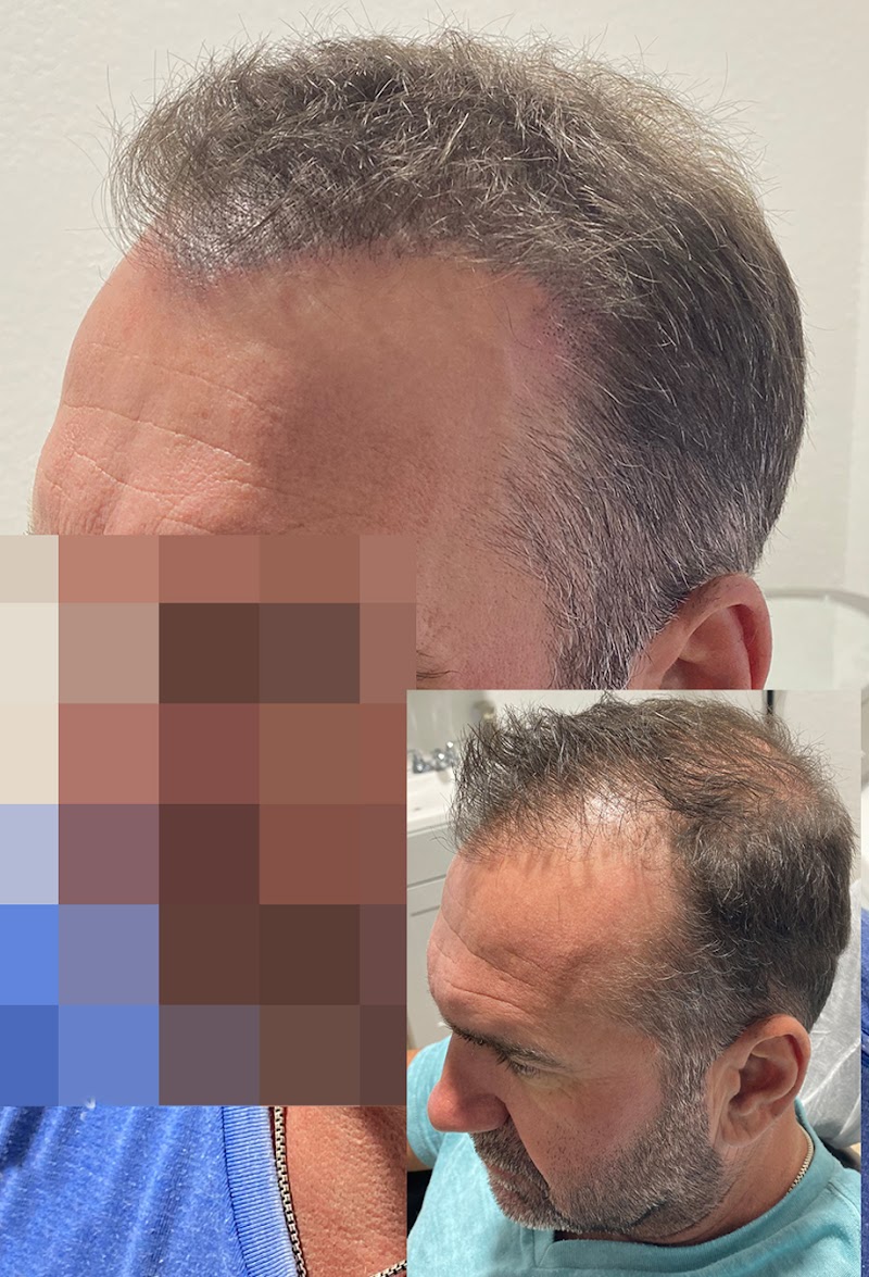 Ultra Scalp Micropigmentation photo 4