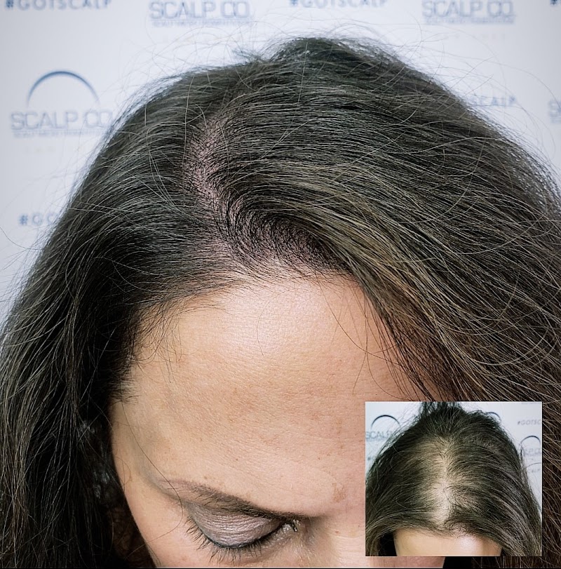 Photo of Scalp Co. Scalp Micropigmentation