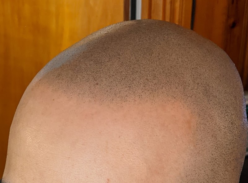 MicroHair Studio (Scalp Micropigmentation) photo 5