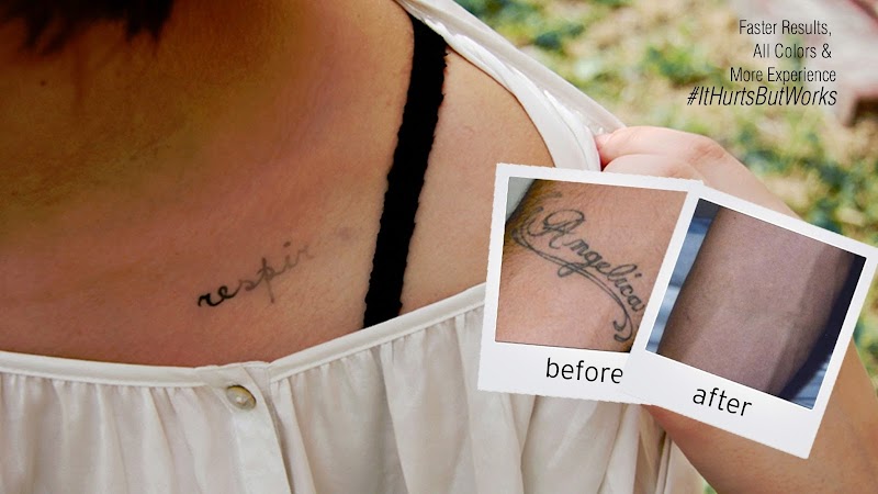 Photo of EradiTatt Tattoo Removal of Palm Harbor/Clearwater