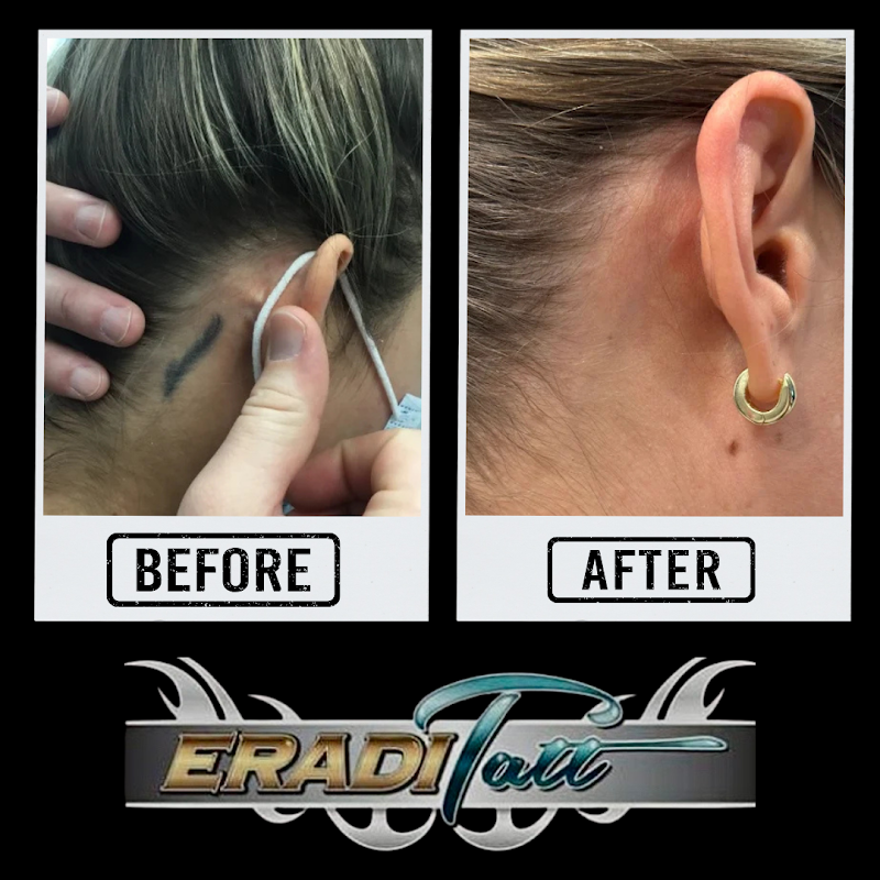 EradiTatt Tattoo Removal of Palm Harbor/Clearwater photo 5